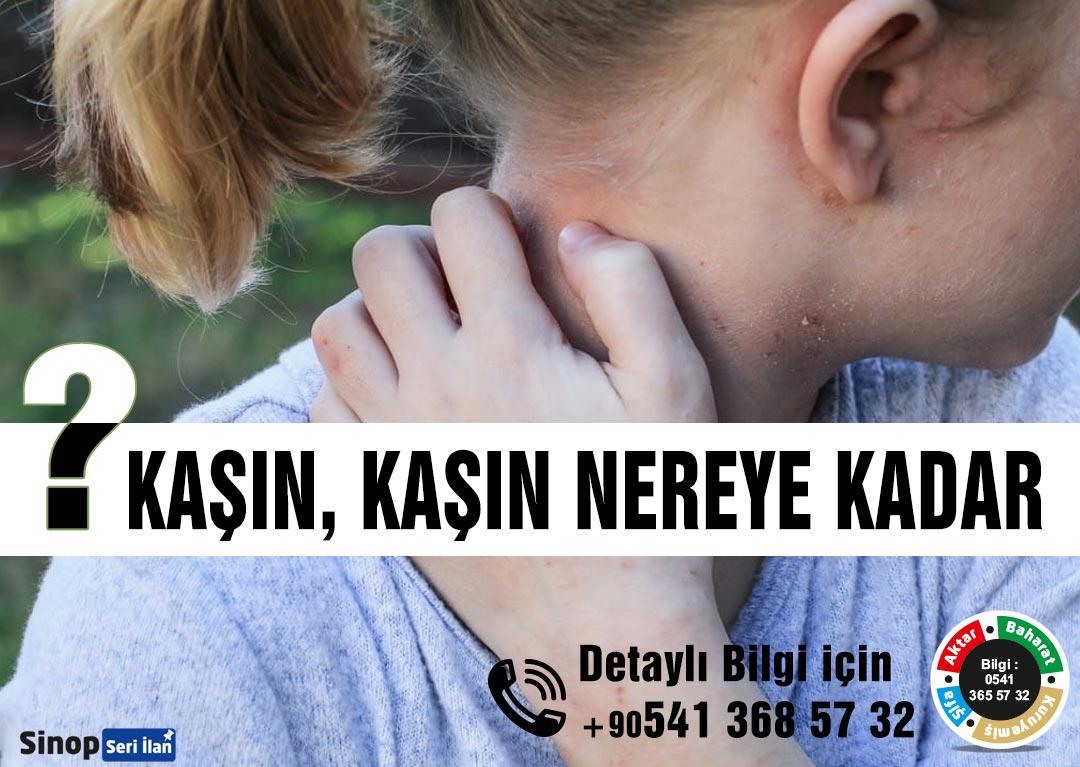 Uyuz hastalığı için öneriler